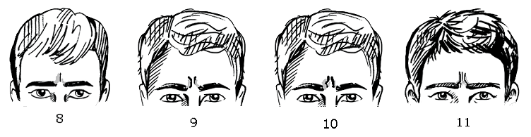 Vertical creases of forehead